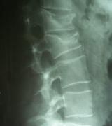 2017-03-03-termin-osteoporose-roentgen-wirbelsaeule-einbrueche.jpg